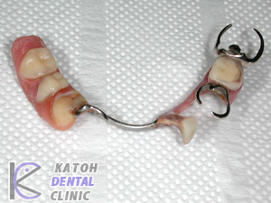 臼歯部インプラント1
