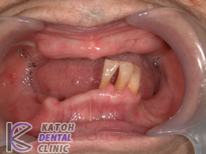 総義歯のインプラント治療(2003年ごろ）
