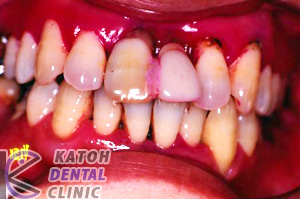 総義歯のインプラント治療(2003年ごろ）