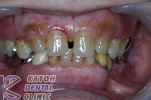 ● 症例24　 臼歯部インプラントと前歯部審美修復 (2006年治療終了）