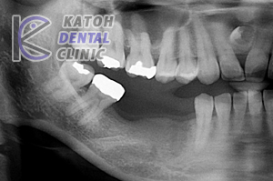 小臼歯部インプラント修復
