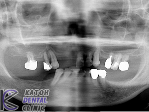 高度の歯周病の症例